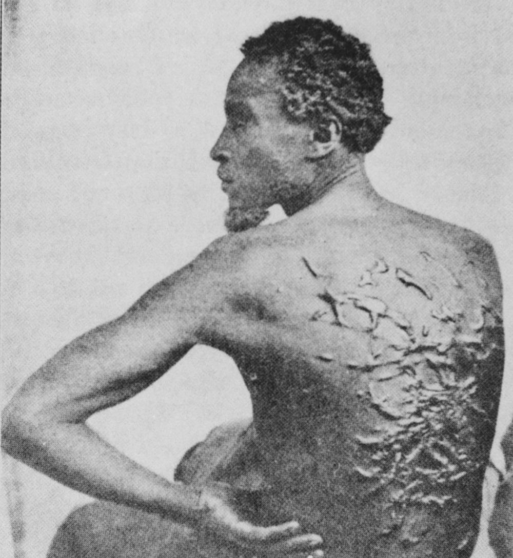 The back of a formerly enslaved African American named Gordon, photographed in 1863 after he escaped to the Union forces. Whipping was one method of punishment suffered by Black people living under bondage in the South.